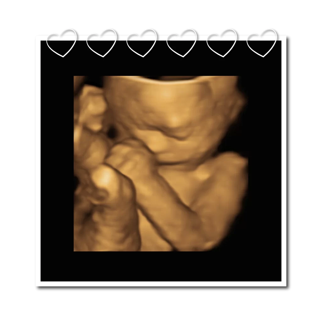 4D Ultrasound scan