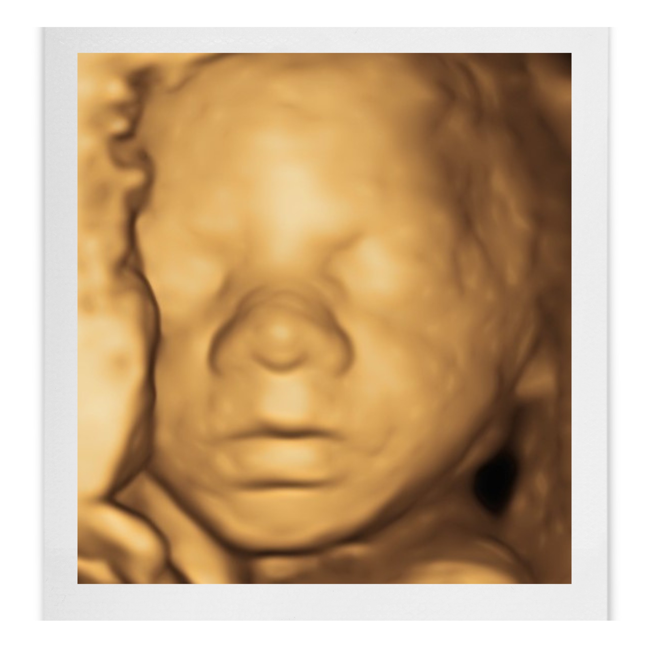4D Ultrasound