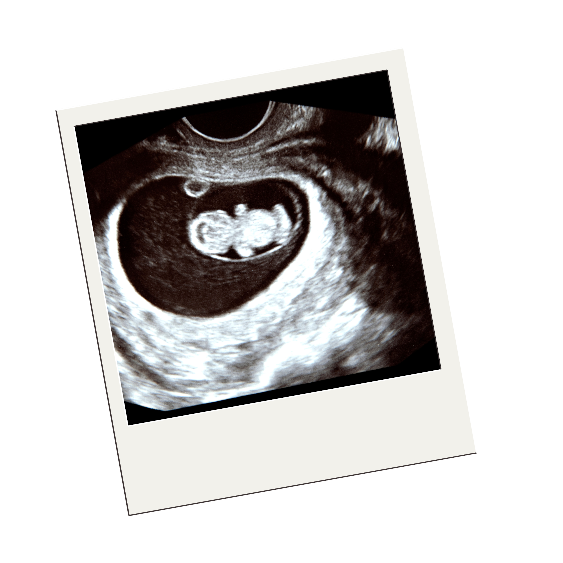 Early Pregnancy Scan