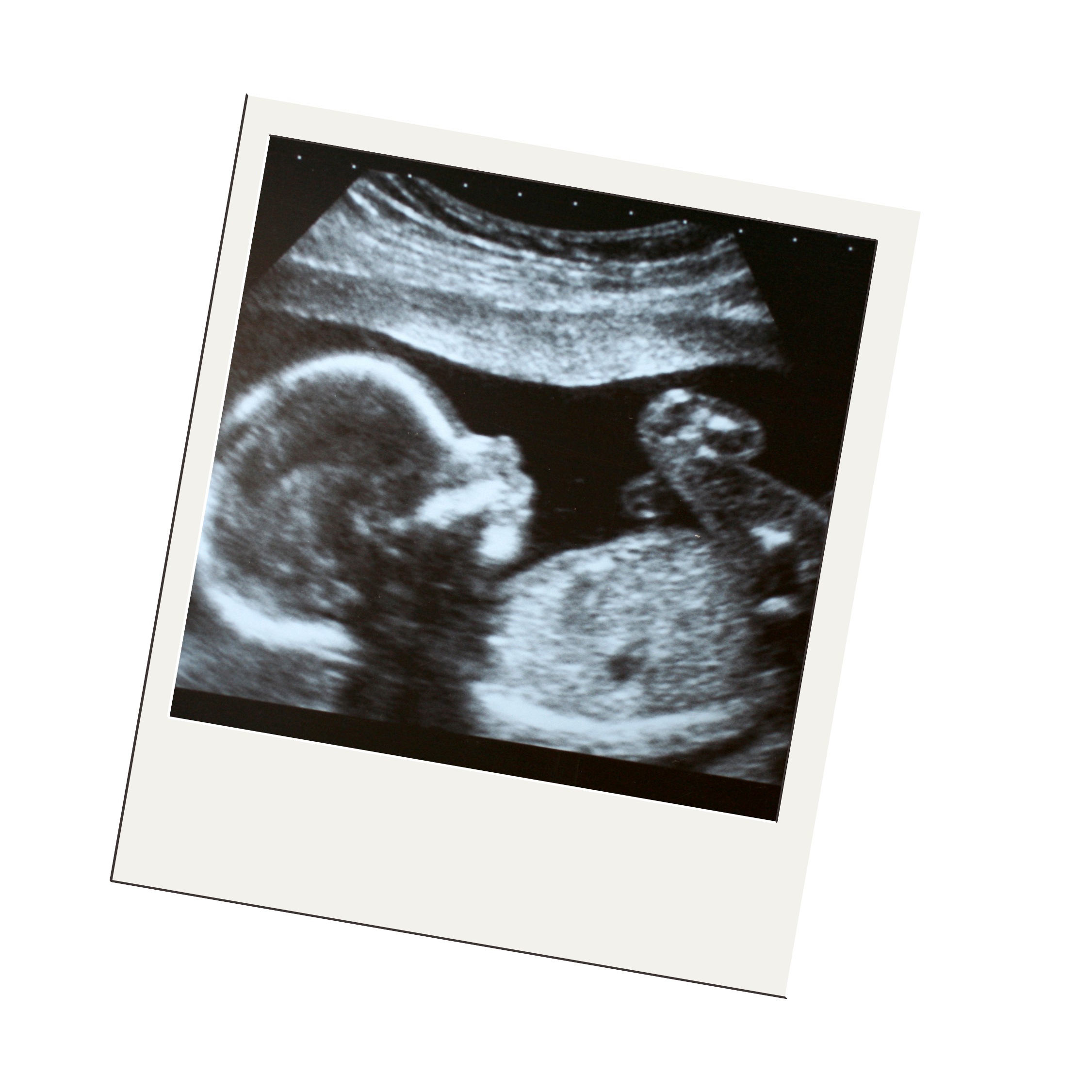 Ultrasound Scan Baby